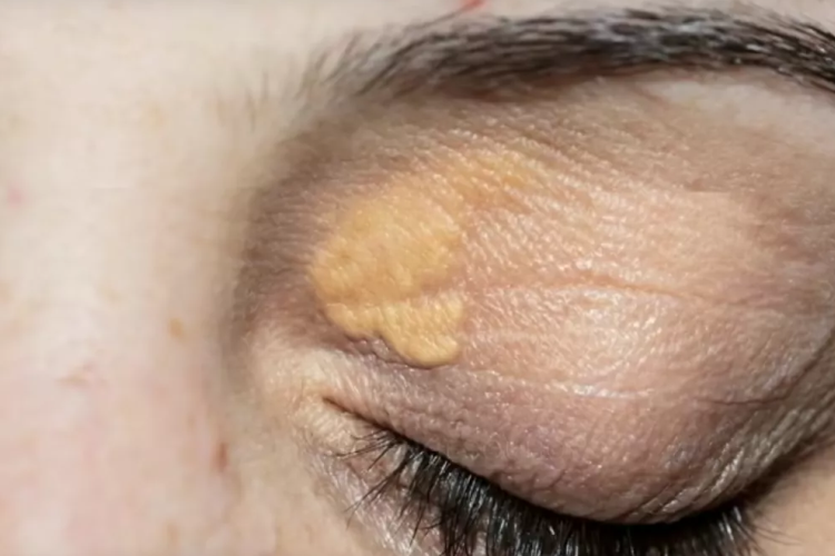 O colesterol pode afetar a visão - CBCO